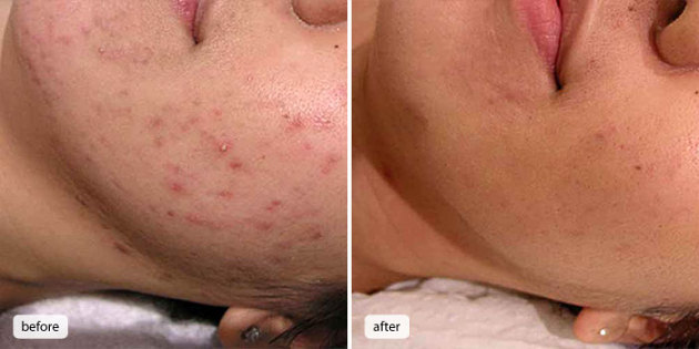 What is minocycline for acne scars